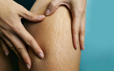 Apa Penyebab Munculnya Stretch Mark?
